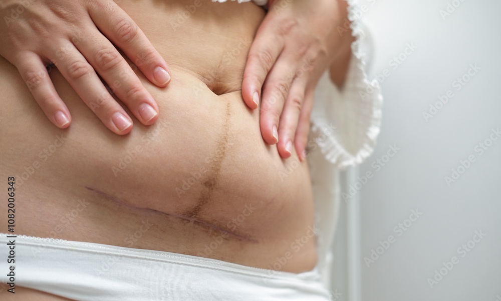 Scar on the abdomen after cesarean C section Scar on the abdomen after cesarean C section
