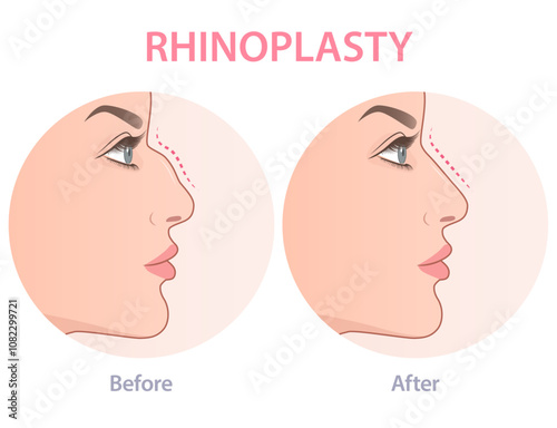 Vector illustration showing rhinoplasty. Female mose plastic surgery infographic.