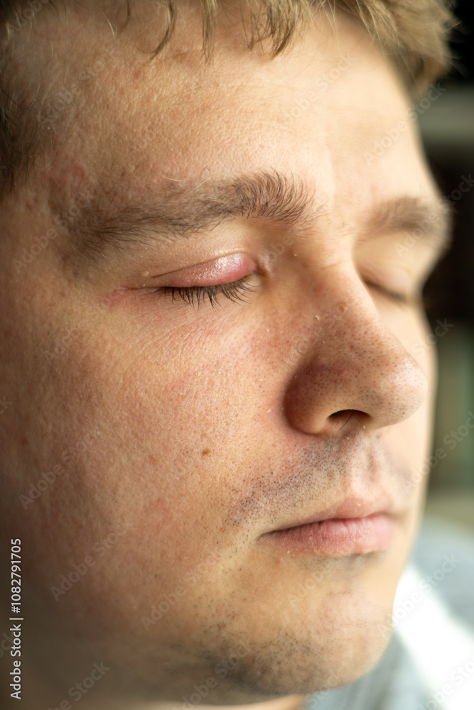 Selective focus on swollen and painful red upper eye lid with onset of stye infection due to clogged oil gland and staphylococcal bacteria. Close up right upper eyelid abscess. Selective focus on swollen and painful red upper eye lid with onset of stye infection due to clogged oil gland and staphylococcal bacteria. Close up right upper eyelid abscess.