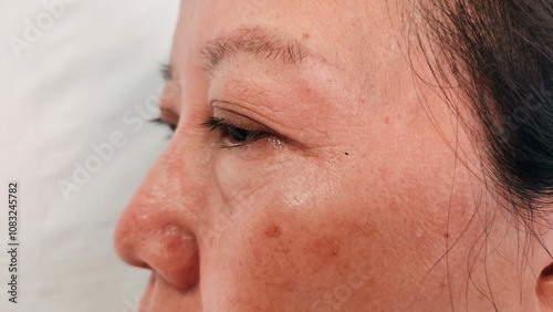 Εκτύπωση καμβά portrait freckles and blemish on the cheek, swelling and ptosis beside the eyelid, dullness and scar on the face of the woman, health care and beauty concept