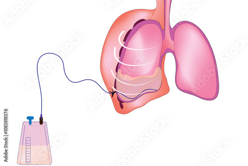 Pleural effusion (Accumulation of excessive fluid in the pleural space, the potential space that surrounds each lung.)