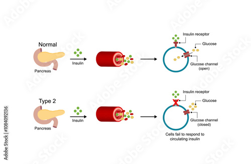  Diabetes mellitus type 2, cells fail to respond to insulin (Insulin resistance). high blood glucose levels. Scientific diagram illustration.