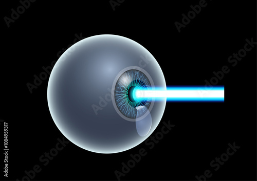 LASIK eye surgery