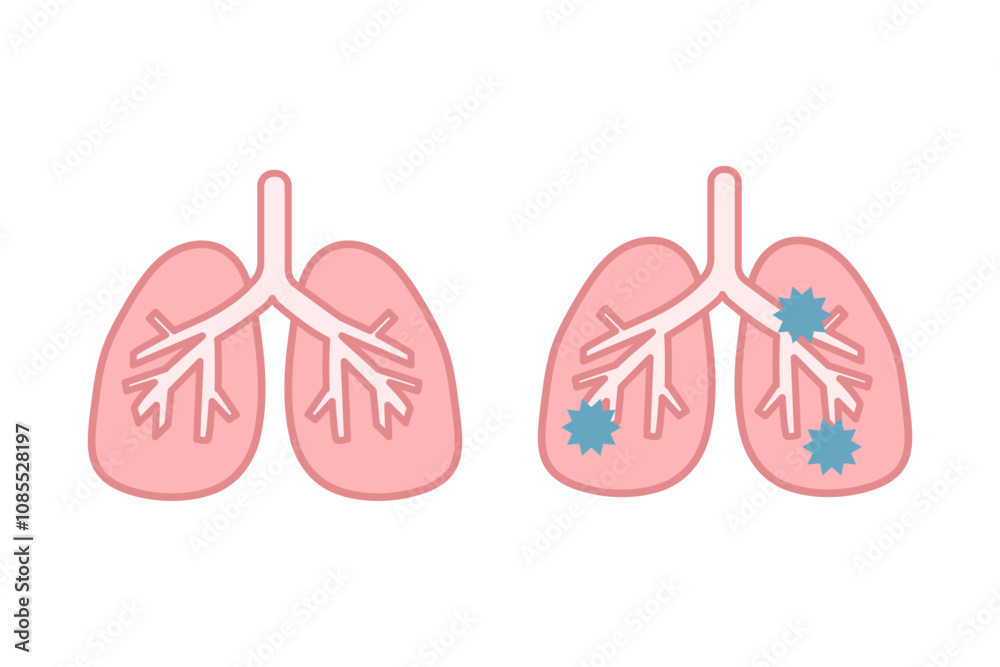 健康な肺と病気の肺のイラストセット
健康な肺と病気の肺のイラストセット