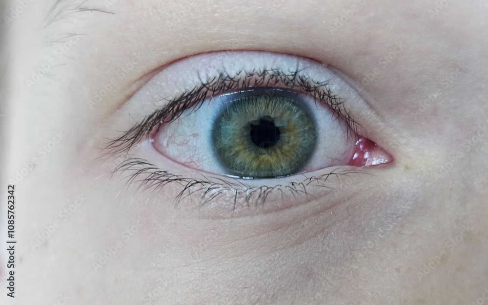 Obraz premium Irritated red blood eye full with capillar net. Conjunctivitis after flu, cold or allergy