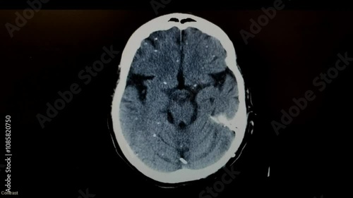 Brain CT with Cysticercosis, hydrocephalus and shunt in place
