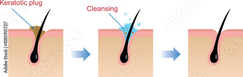 Structure illustration of pores Clear keratotic plug (whiteheads ,blackheads ) with cleansing.
