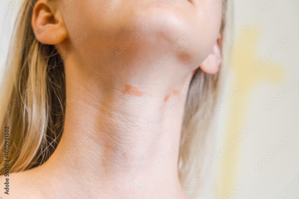 View on woman's neck with red spots isolated. Atopic dermatitis, psoriasis or eczema, inflammatory or allergies View on woman's neck with red spots isolated. Atopic dermatitis, psoriasis or eczema, inflammatory or allergies
