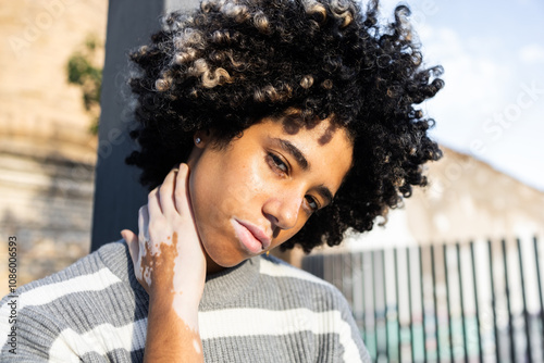 Relaxing University Day, Mixed Race Woman with Vitiligo