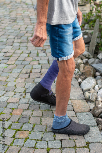 middle-aged man walks along a rocky path with a broken leg in a purple fibreglass cast, his foot shod in a special walking sandal,concept of an active lifestyle despite the limitations of an injury, photo