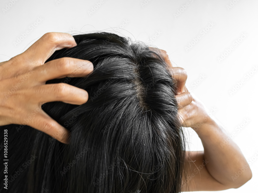 Obraz premium Dandruff Itchy scalp, woman chtatch hair messy she dirty, sensitive disease bacteria dander loss, concept for medicine hyginene champoo treatment skin for good health.