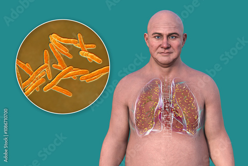 Miliary tuberculosis, and close-up view of Mycobacterium tuberculosis bacteria, 3D illustration photo