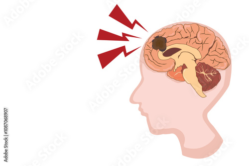 brain cancer, glioblastoma illustration. vector eps 10
