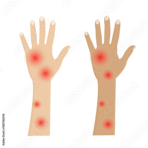 vector: red bumps on the skin of the hands due to allergies or insect bites