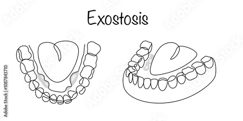 Exostosis Mouth