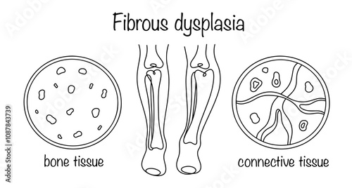 Fibrous dysplasia