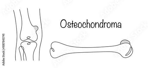 Osteochondroma