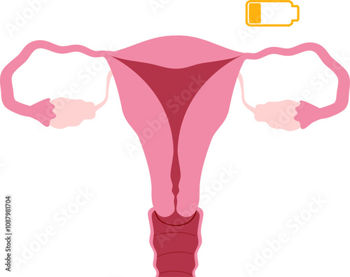 Ovarian disease illustration. 