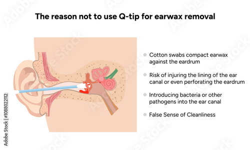 The reason not to use q-tip for earwax removal. Medical information