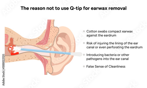 The reason not to use q-tip for earwax removal. Medical information