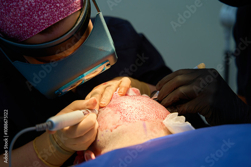 Close-up of surgeon performing hair transplant with precision tools photo