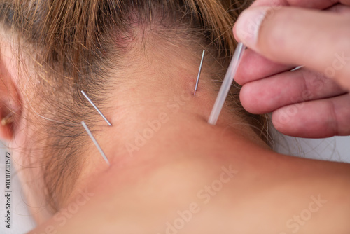 A physical therapist performs dry needling on a patients neck to alleviate muscle tension. The patient lies face down on a therapy table, receiving precise needle placement for targeted relief