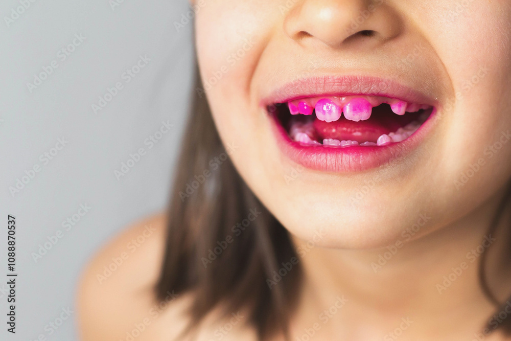 Close up of 7 year old girl's teeth with pink plaque indicator solution applied to teeth, concept of dental hygiene and health Close up of 7 year old girl's teeth with pink plaque indicator solution applied to teeth, concept of dental hygiene and health