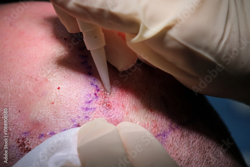 Close-up of a hair transplant procedure in progress