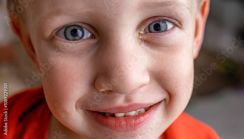 Conjunctivitis in the eyes of a child, pus and inflammation of the eyes of a baby boy close-up photo