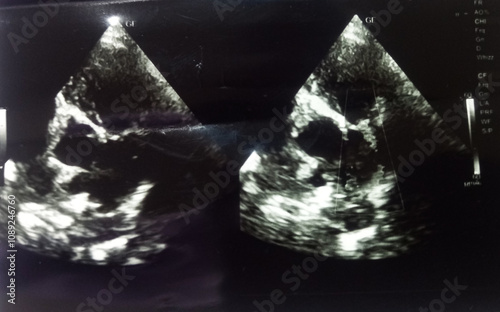 Severe Pulmonary stenosis with pulmonary  hypertension of echocardiography in a patient. RA and RV diluted.