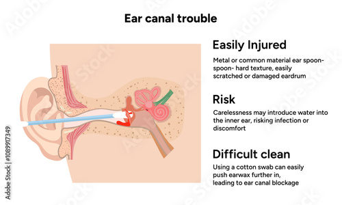The reason not to use q-tip for earwax removal. Ear canal trouble. Medical information