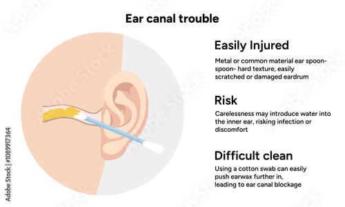 The reason not to use q-tip for earwax removal. Ear canal trouble. Medical information
