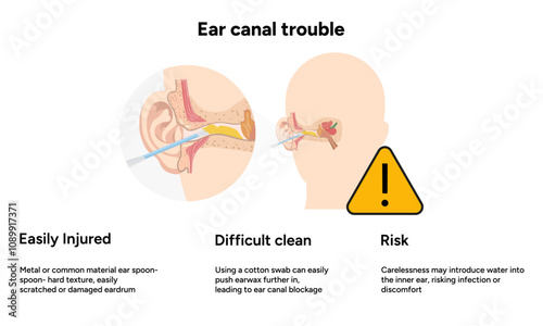 The reason not to use q-tip for earwax removal. Ear canal trouble. Medical information