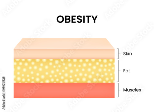 Diagram of Obesity and overweight layers skin