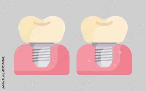 dental implant abutment fixture teeth tooth collection