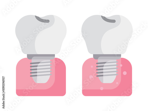 dental implant abutment fixture teeth tooth collection