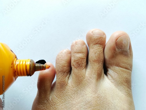 Toenail wound treated with medication and white background.