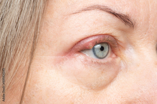 Bacterial infection stye on upper eyelid with purulent bump on eye of woman.