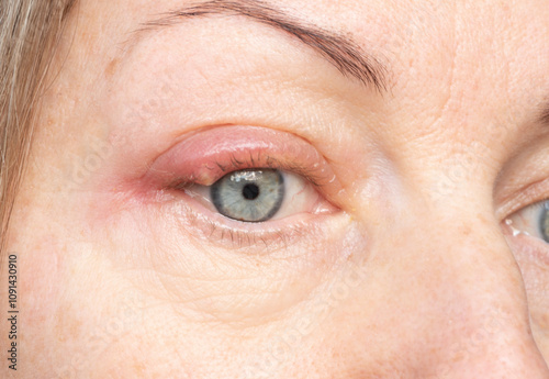 Acute purulent stye (chalazion) on a woman's eye.