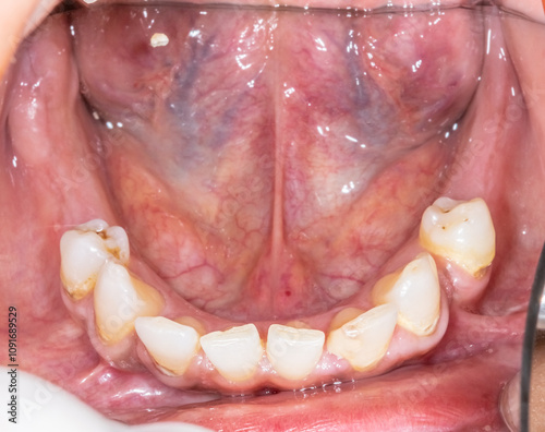 Foto Front view close-up of a prosthodontic dentistry case