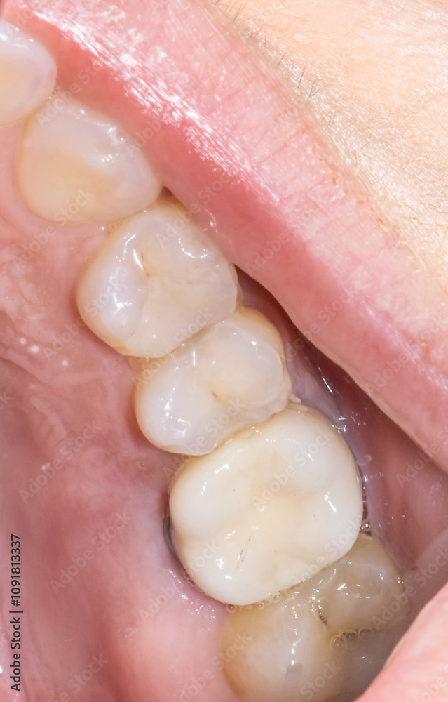 Fototapeta premium Part of the upper maxillary jaw with an aesthetic composite restoration on a premolar, an unaesthetic ceramic crown on a molar, and a decay on the last tooth. Close-up view of a dentistry patient case