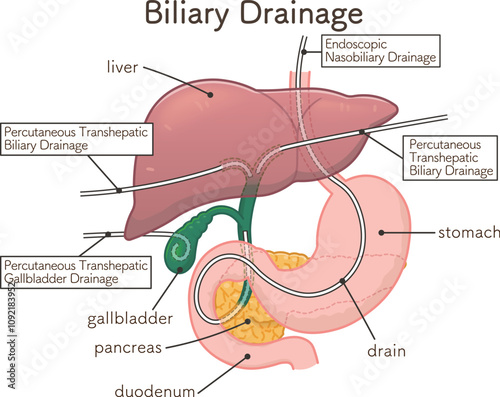 胆道ドレナージのイラスト、Biliary Drainage