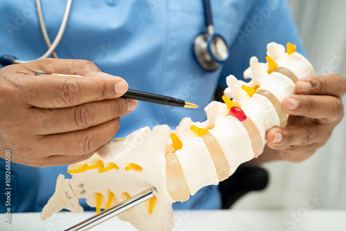Tableau sur toile Asian doctor holding spinal nerve and bone model, Lumbar spine displaced herniated disc fragment for treatment medical in the orthopedic department