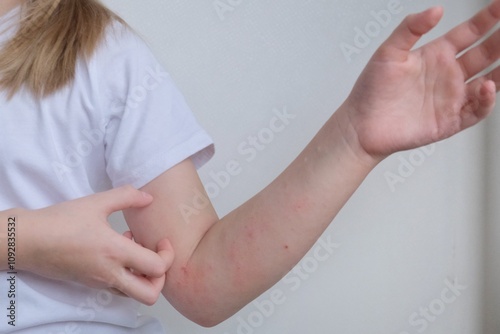 The child scratches atopic skin. Dermatitis, diathesis, allergy on the child's body.	