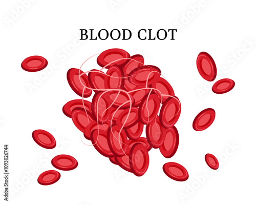 Thromboembolism. Circulating blood clot. Red blood cell. Vector illustration.