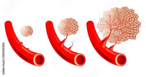 Medical illustration of angiogenesis progression. photo