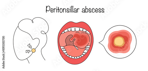 Peritonsillar abscess