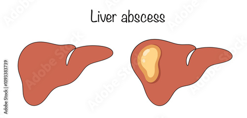 Liver abscess