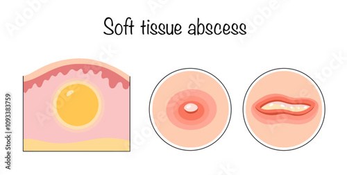 Soft tissue abscess