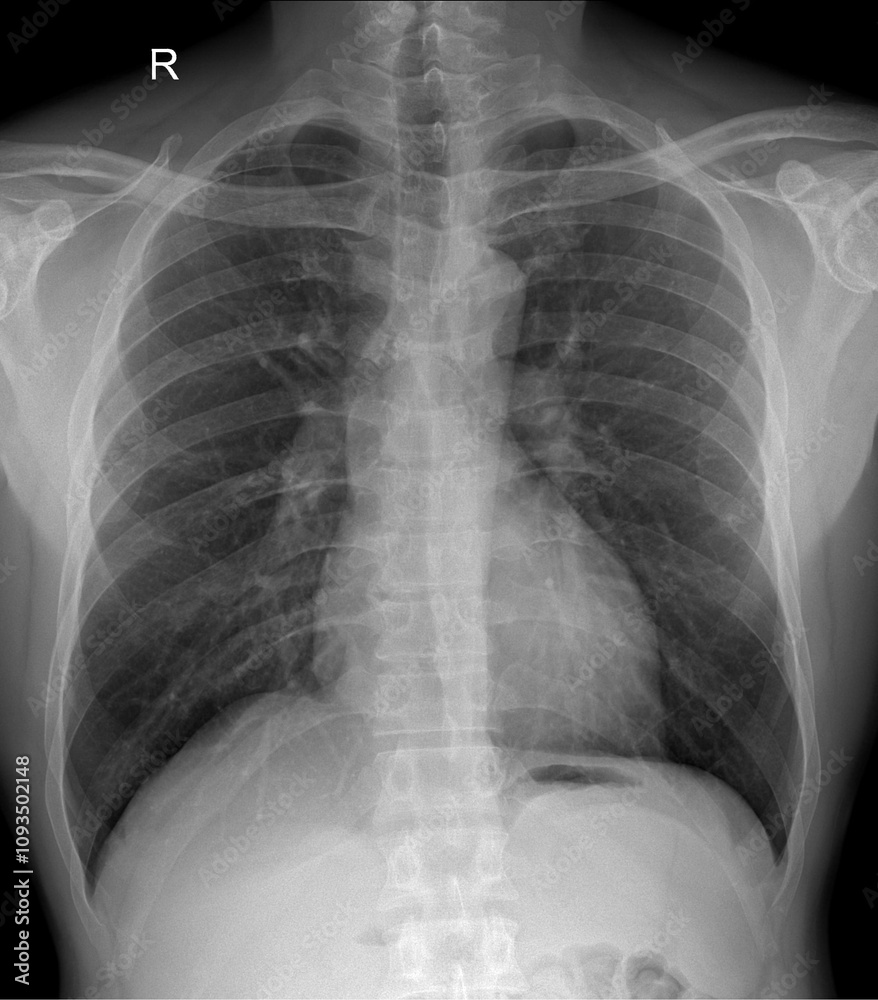 Heart Imaging Through High-Resolution Chest X-Rays Heart Imaging Through High-Resolution Chest X-Rays